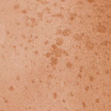 Tratamento para Manchas em Ceilândia