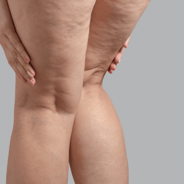 Tratamento para Lipedema em Ceilândia