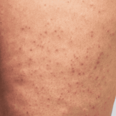 Tratamento para Foliculite em Ceilândia