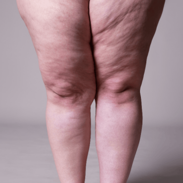 Enzimas para Lipedema em Ceilândia
