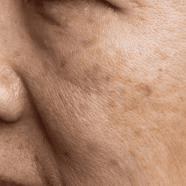Melasma e Manchas em Ceilândia