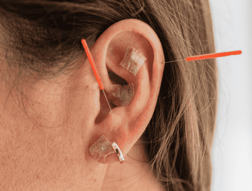 Auriculoterapia