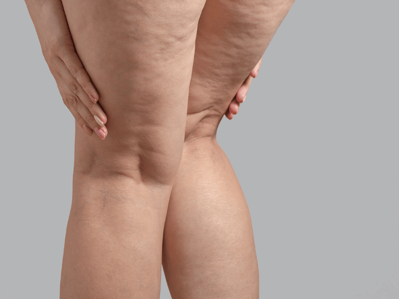 Tratamento para Lipedema