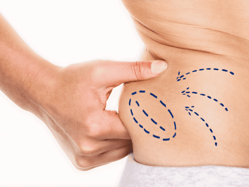 Hidrolipo