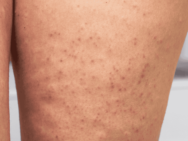 Tratamento para Foliculite em Ceilândia