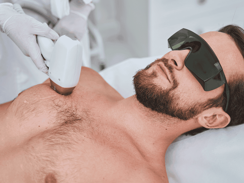 Depilação a Laser Masculina