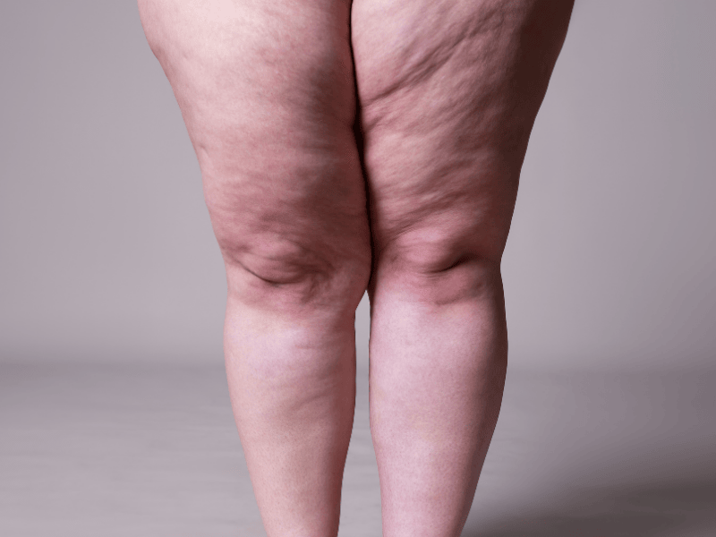 Enzimas para Lipedema