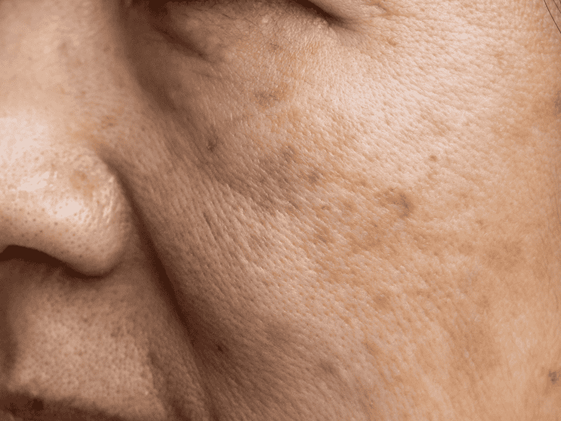 Melasma e Manchas